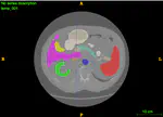 U-Net for Medical Image Segmentation